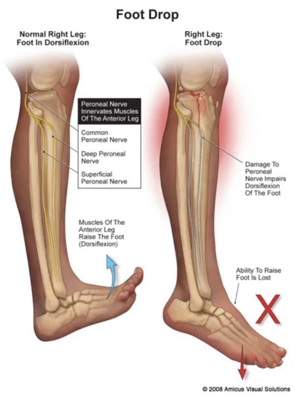 Peroneal Nerve Foot Entrapment What You Should Know MY Sports Injury 